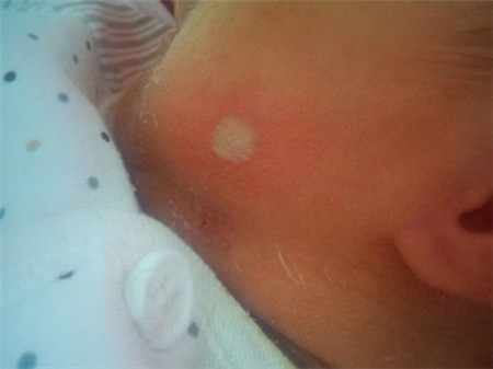 新生儿脓疱疹怎么治疗,分为局部治疗和全身治疗