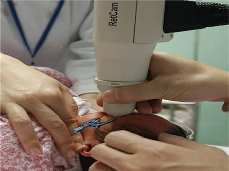 早产儿什么情况需要做眼底筛查早产的新生儿