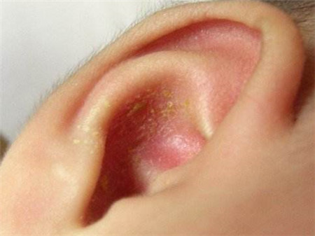 新生儿耳朵流黄水怎么回事