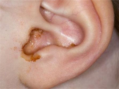 新生儿耳朵流黄水怎么回事