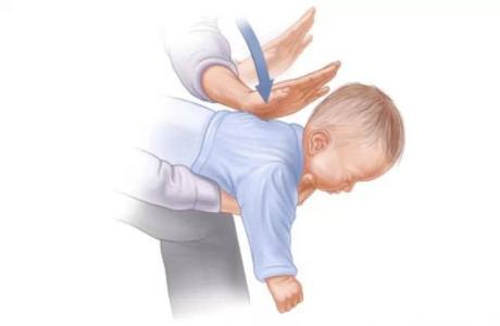 急发生呛奶窒息(胃内空虚),应将其俯卧在抢救者腿上,上身前倾45-60度