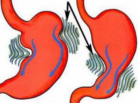 当胃壁肌层缺损时,胃收缩的拉力不均匀,可造成胃的破裂.