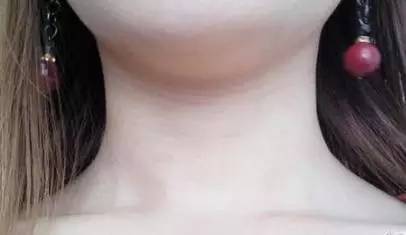  脖子粗是什么原因:后脖颈处脂肪
