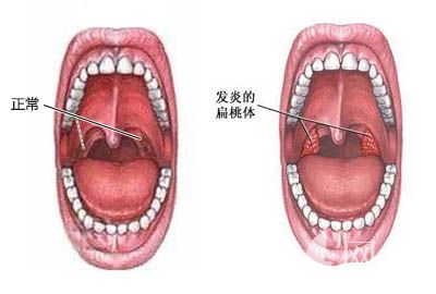 正常咽扁桃体图片图片