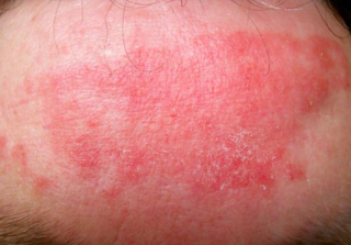 假性湿疣是什么怎么区分假性湿疣和尖锐湿疣