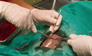 女性的输卵管结扎术,有很多的优点:性生活不再受到干扰,一劳永逸,手术