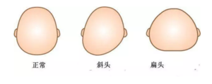 婴儿正常头型什么样的 婴儿正常头型图片正面侧面