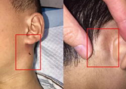 小孩淋巴结肿大怎么办小孩淋巴结肿大危险吗