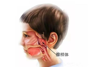 孩子腺样体肥大和过敏有关系吗孩子腺样体肥大如何调理